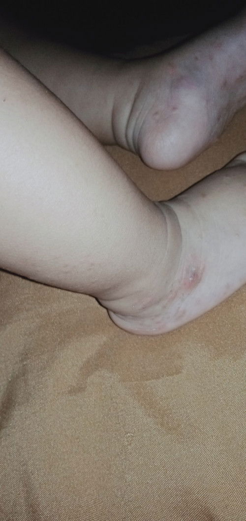 Bintik bintik merah pada bayi