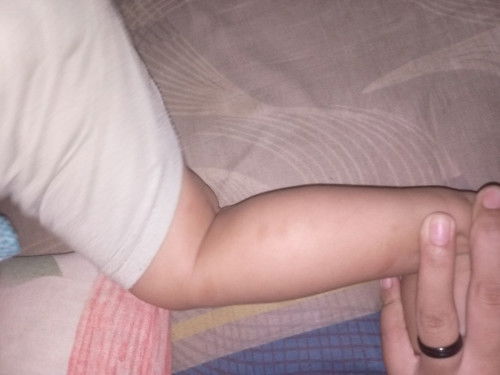 Menghilangkan bekas gigitan nyamuk