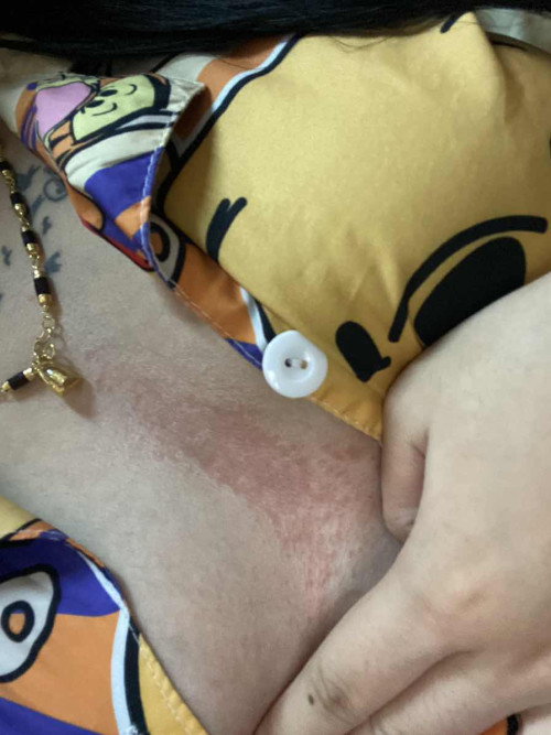 แม่ท้องบ้านไหนเป็นผื่นแดงแบบนี้บ้างคะ