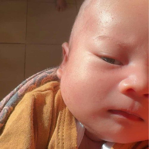 Bintik2 merah dimuka bayi