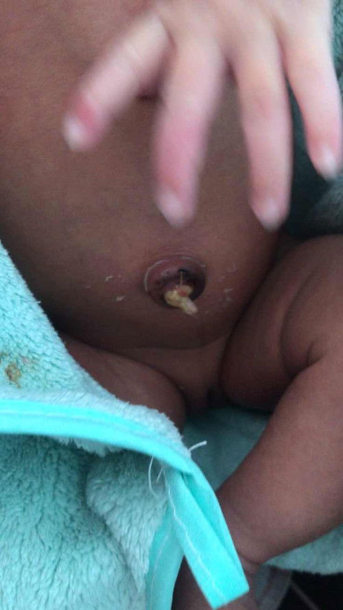 Perawatan tali pusat yang sudah puput