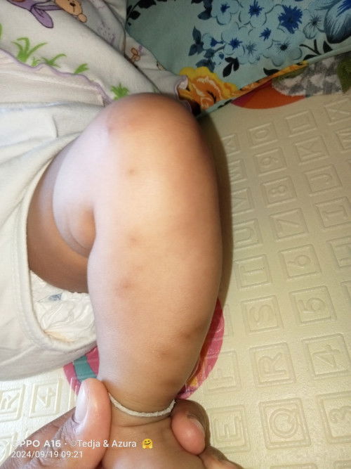 Ngilangin bekas gigitan nyamuk