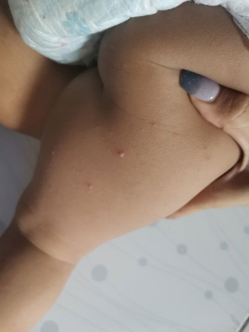 แม่บ้านไหนเคยเป็นแบบลูกบ้านนี้บ้างไม่รู้ ว่ามันคือตุ่มอะไร มียาอะไรบ้างที่ทานแล้วยุบลงบ้าง