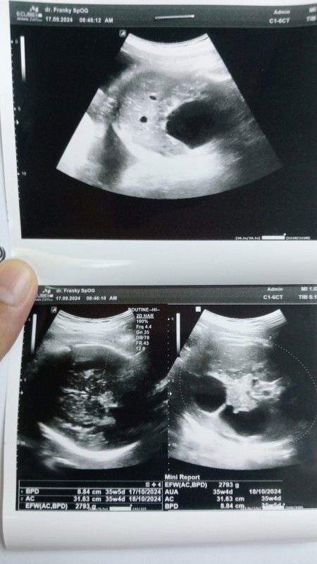 USG 37mg perbedaan sebelum dan sesudah usg