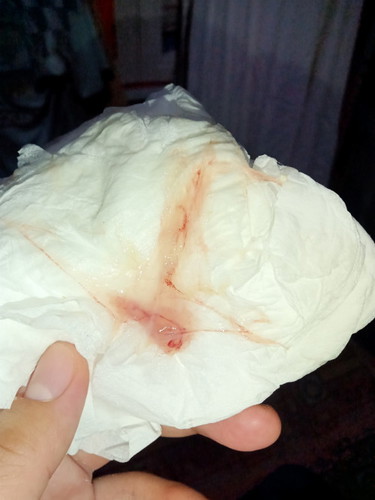 แม่ๆแบบนี่ไปหาหมอเลยไหมคะ ท้องได้ 36+3 สัปดาห์