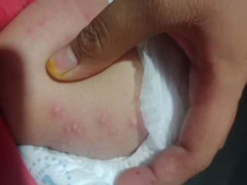 badan bayi bintik bintik berair