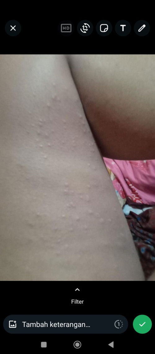 Bentol yg sangat gatal