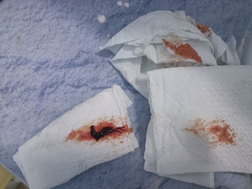 ตรวจอัตราซาวด์มดลูก TVCL (วัดความยาวมากลูก)