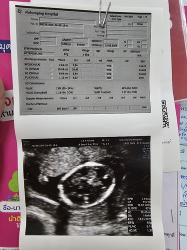 การตรวจดาวน์ซินโดรม