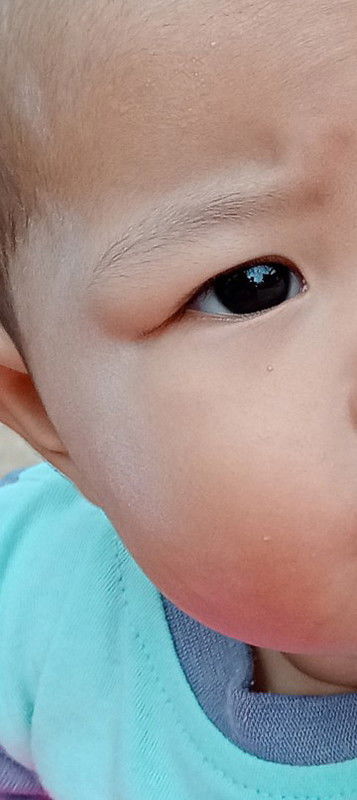 เป็นตุ่มขึ้นที่หางคิ้ว