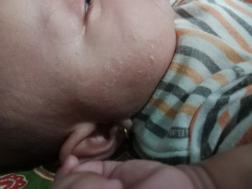 Pipi merah dan kering