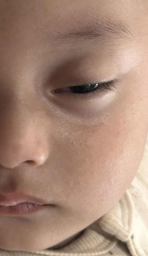 kulit wajah beruntusan