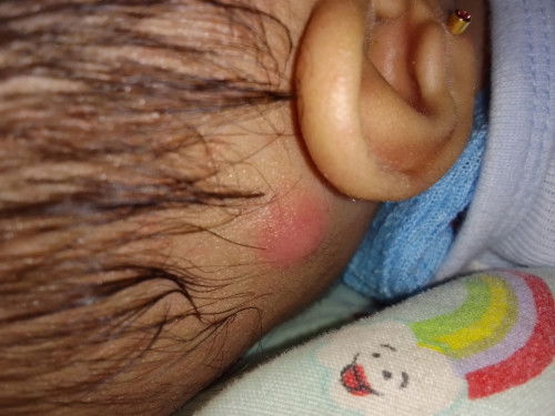 Benjolan merah seperti bisul