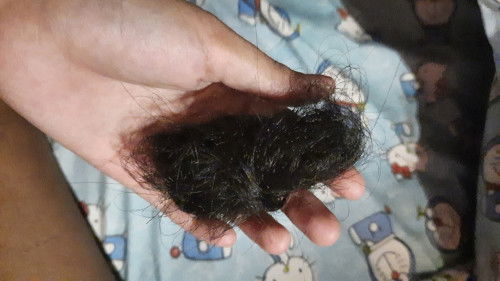 Busui rambut rontok parah