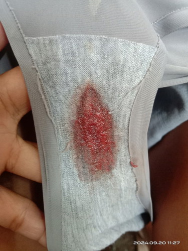Implant bleeding po ba to?