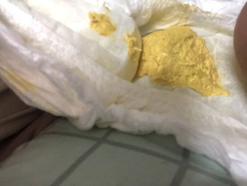 ลูกอึเเบบนี้ปกติไหมคะกินนมผงค่ะ