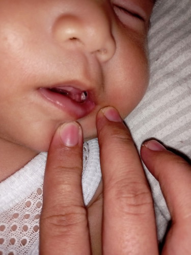 Tanong ko lang po kung bakit ganto na may bukol sa gums Ng baby ko?