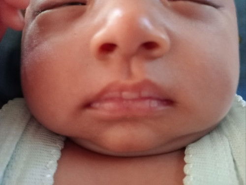 bibir ngelupas pada bayi