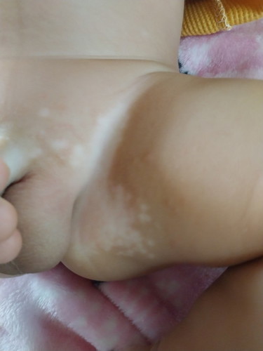 ลูกชายเป็นผื่น
