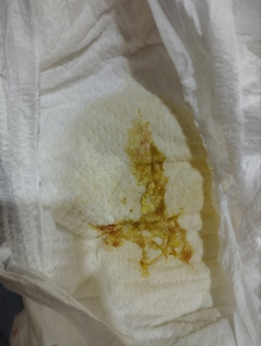 may dugo sa dumi ni lo