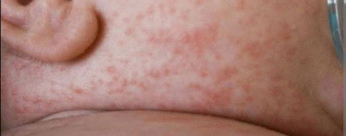 Bintik merah pada leher newborn