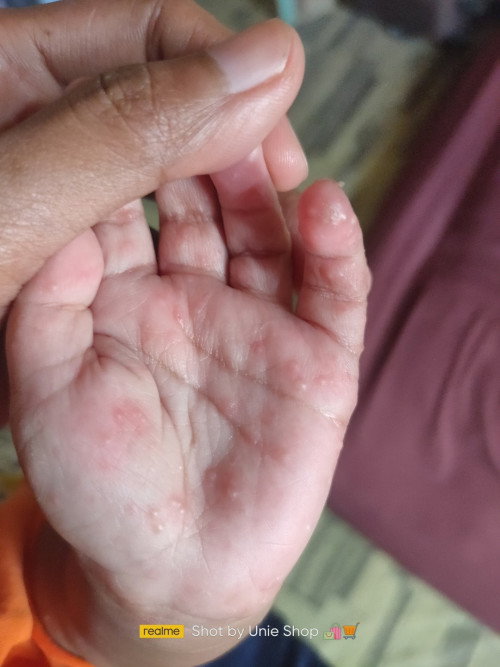 Gatal pada bayi 5 bulan