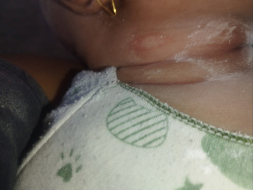 Mau tanya Bun cara mengatasi ruam pd bayi umur 2bln gimana ya & klo BLH tau ap penyebabnya dri asi ?