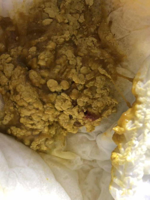 น้องอึมีลักษณะมูกใสปนและมีเลือดนิดหน่อย