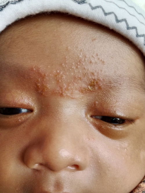 Bintik bintik di muka