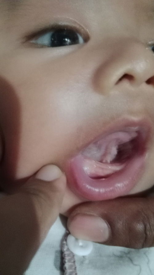 titik putih di gusi bayi