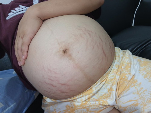 Help po, ano pong gamot sa stretchmark? 😭