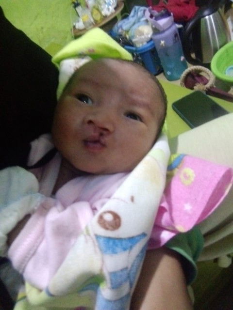 Anaak celah bibir dan llangit langit