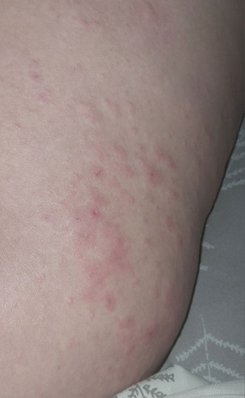 Gatal gatal di perut