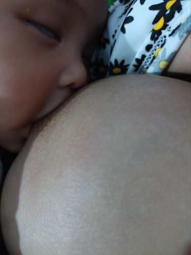 mastitis gak sembuh sembuh