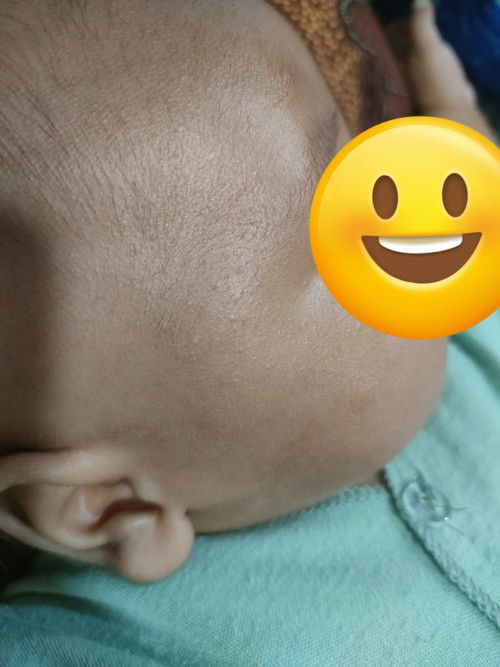Bayi 2 bulan bruntusan