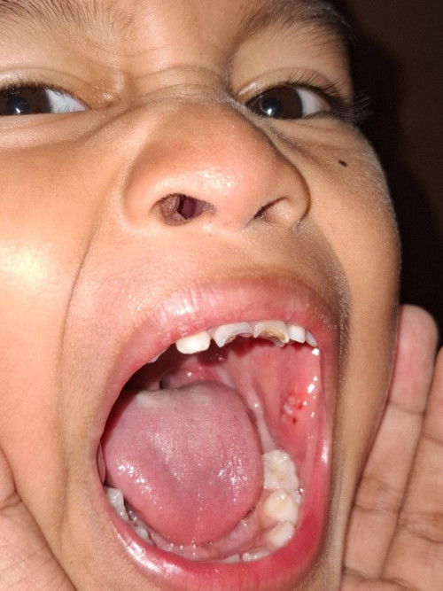 Sariawan atau bukan?