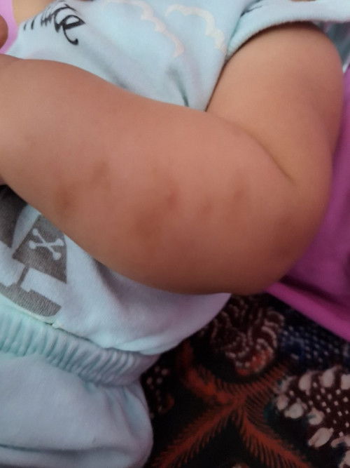 Bekas gigitan nyamuk