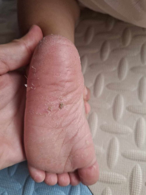 ลูก1ขว​บมือเท้าลอกบ่อยมาก