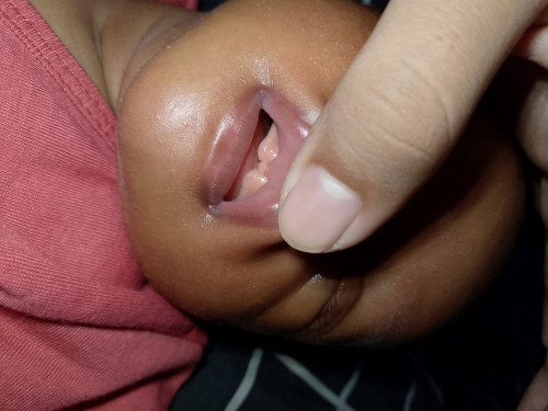 Lip tie pada bayi