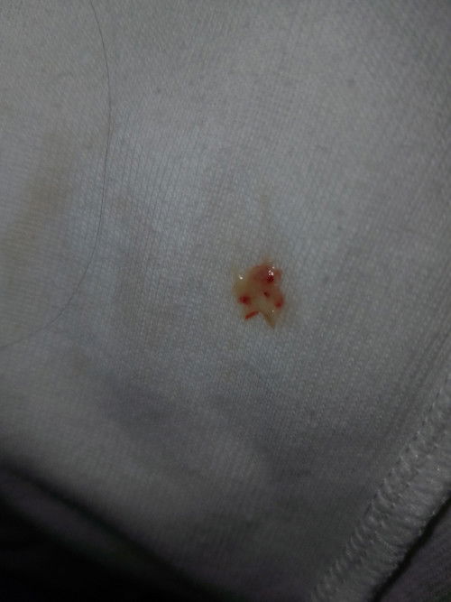 Pasintabi po.. Mga mommy ano po kaya ito lumabas sken may konti dugo pati sa ihi ko..