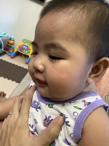 Skin rash or allergy #5/6mos