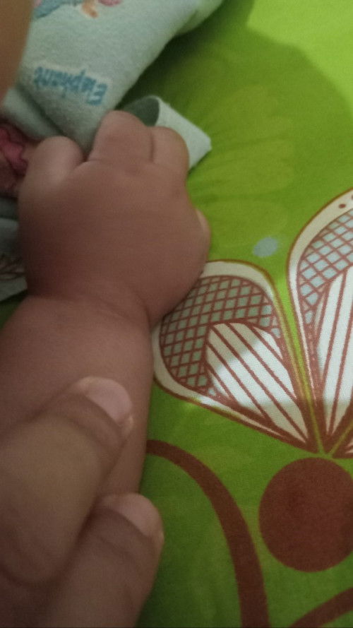Kulit kering dilipatan tangan bayi