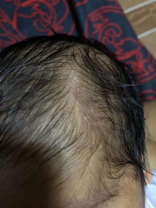 Acne ba to ?? O Ano ??? Normal po ba Ito