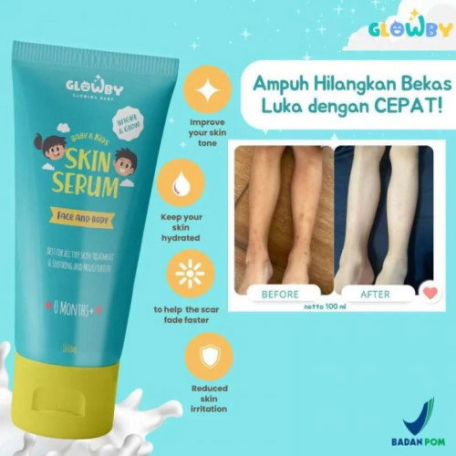 #SeriusTanya - Produk untuk hilangkan bekas gigitan nyamuk yang menghitam