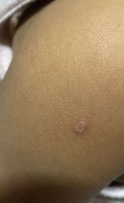 สอบถามค่ะมันคือตุ่มอะไร