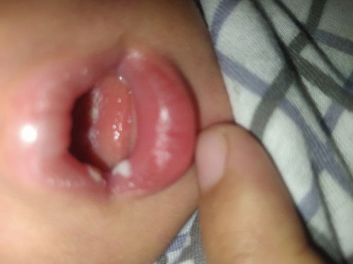 Bercak putih dimulut bayi