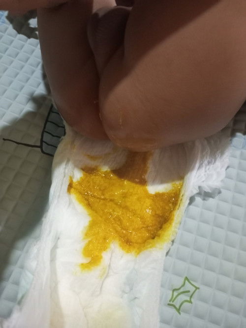 infeksin pencernaan, diare pada anak usia 5 bulan