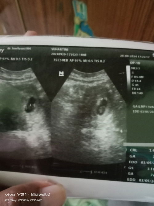 Bun serius tanya apa itu yg kecil itu janin..? Karna wktu USG gak smpet tnyak, keburu mual"hamil 7m