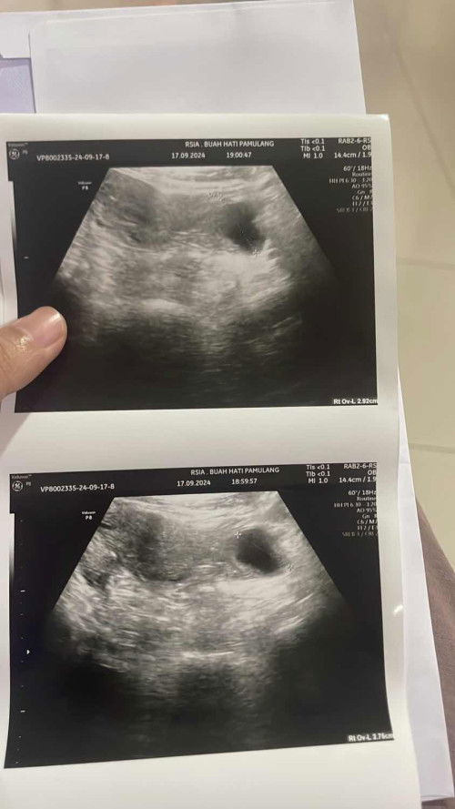 Sharing tentang kista