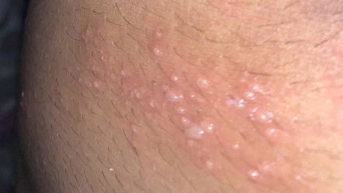 Shingles a.k.a Herpes Zoster